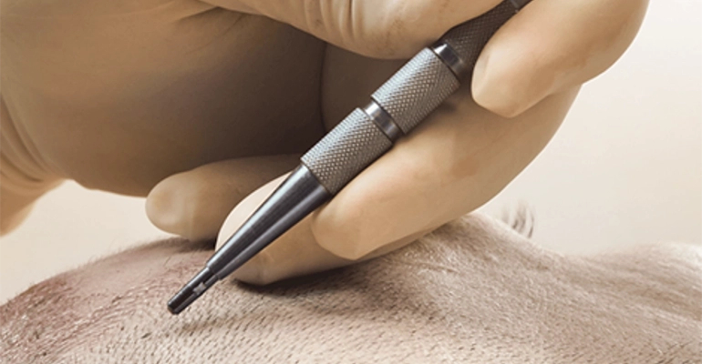 Sapphire FUE Hair Transplant