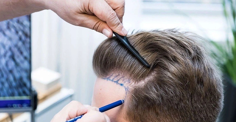 Unshaven Hair Transplant